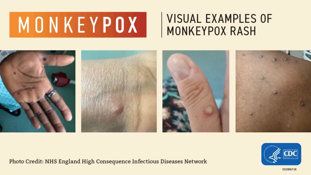 ddb2e3ba ba92 4bb7 bbbe 990b31c3c818 Monkeypox visuals from CDC